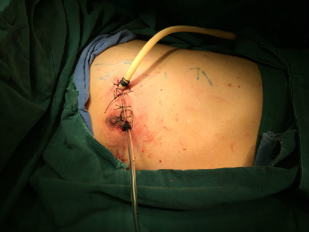  黄蜂三球接受左腕手术根治  